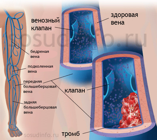 Тромбофлебит нижних конечностей лечение препараты схема лечения симптомы у женщин после 60