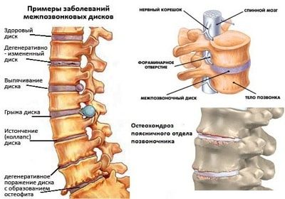 Симптомы и лечение поясничного остеохондроза в домашних условиях