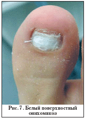 Как и чем лечить запущенный грибок ногтей на ногах