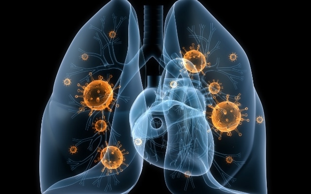 Пневмония - симптомы и признаки воспаления легких у детей и взрослых