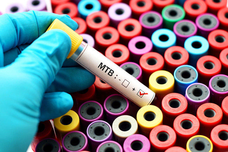 Как распознать туберкулез: причины, симптомы, лечение