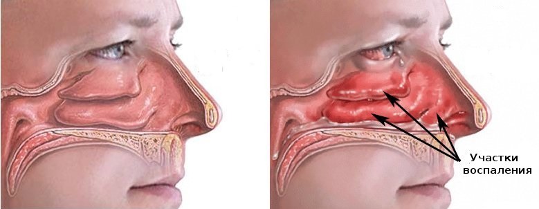 Вазомоторный ринит: 7 причин приводящих к заложенности носа