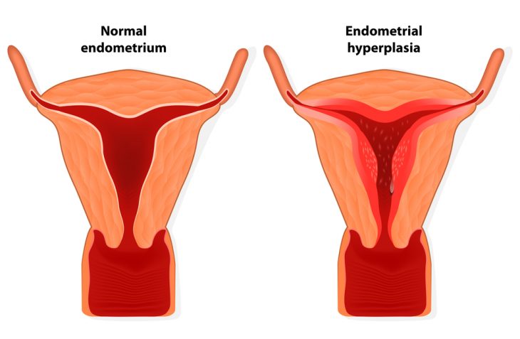 Гиперплазия эндометрия и полипы матки: что значит, как перестать бояться и избавиться